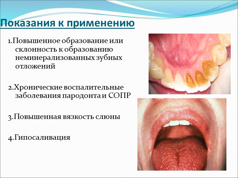 Показания к применению 1.Повышенное образование или склонность к образованию неминерализованных зубных отложений  2.Хронические